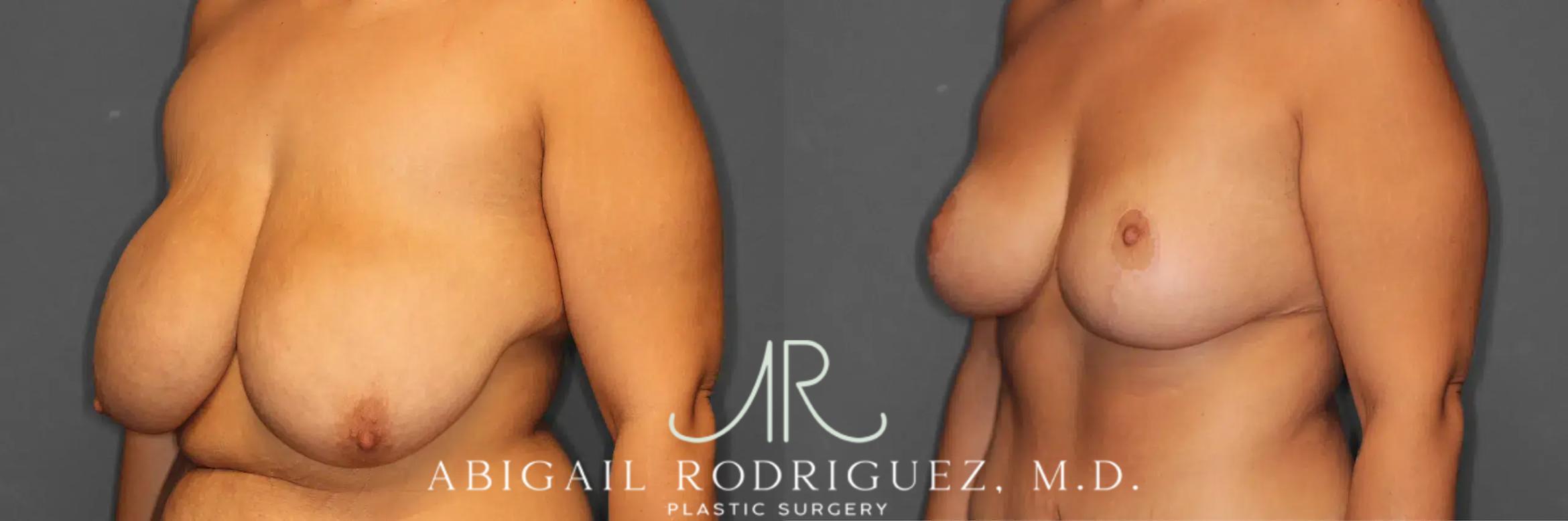 Before & After Breast Lift Case 259235 View 3 View in Houston, TX