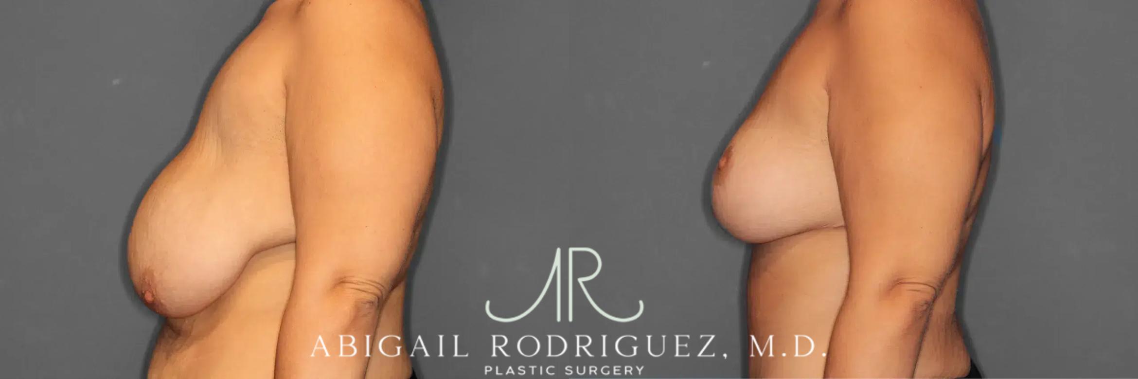 Before & After Breast Lift Case 259235 View 4 View in Houston, TX
