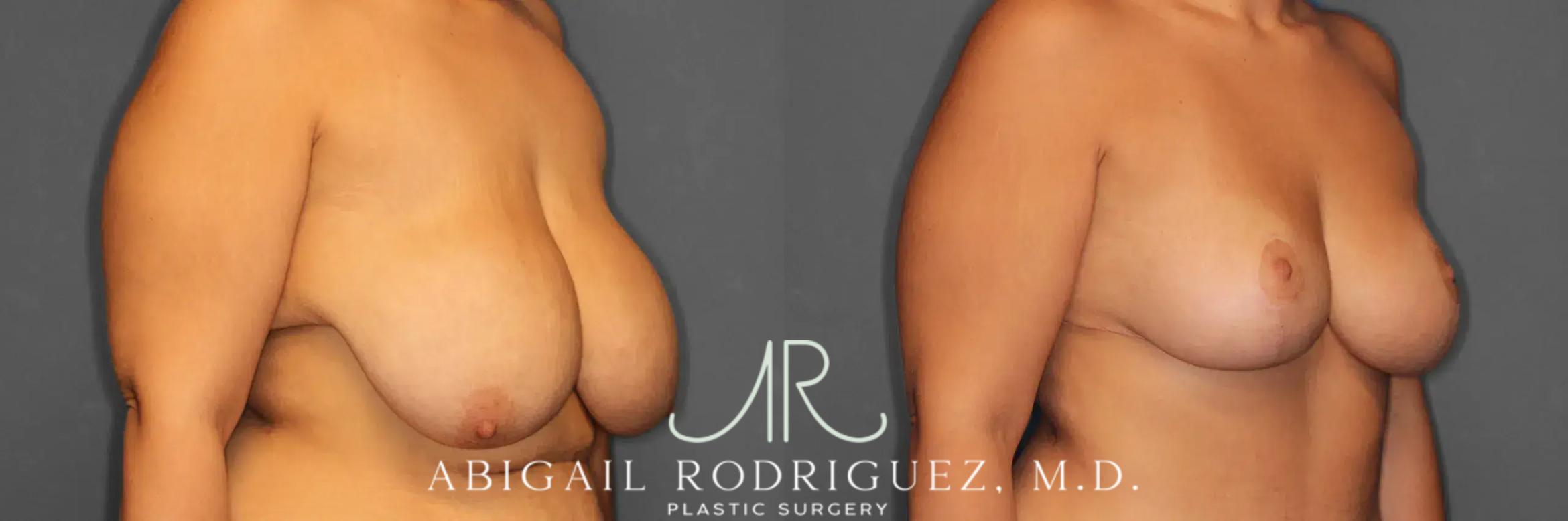 Before & After Breast Lift Case 259235 View 5 View in Houston, TX