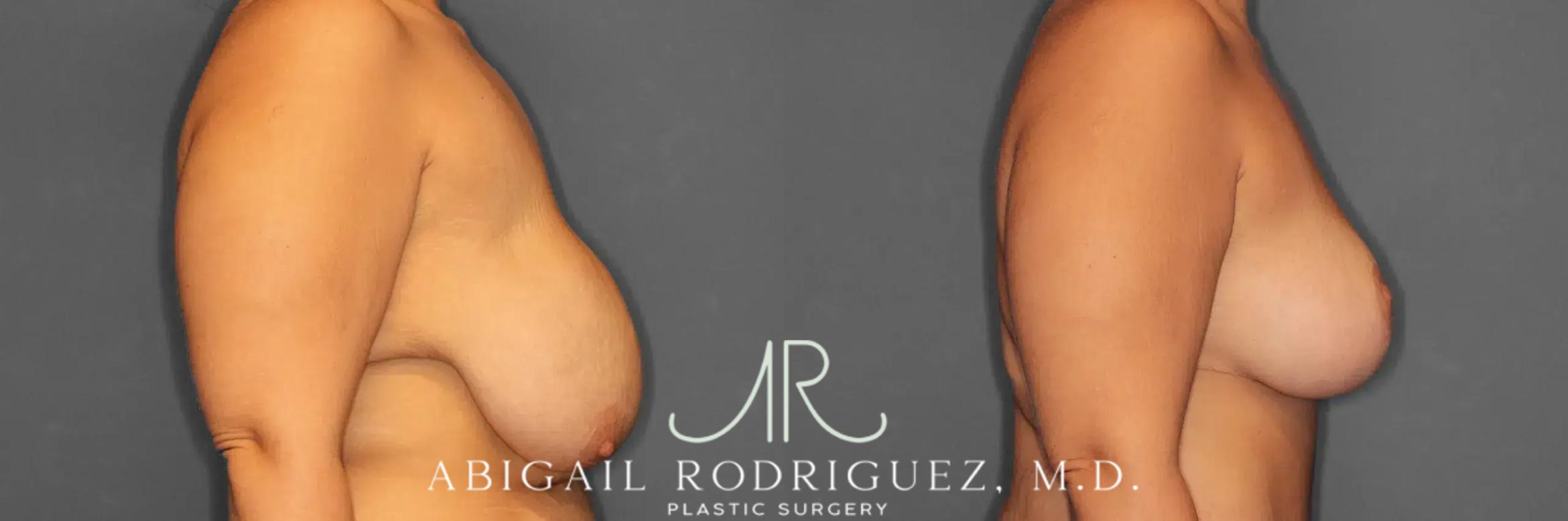 Before & After Breast Lift Case 259235 View 6 View in Houston, TX