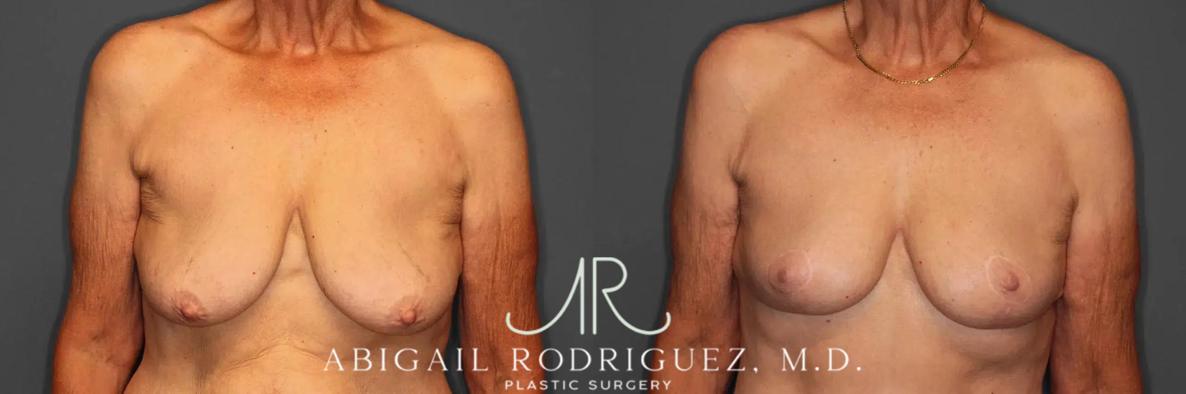 Before & After Breast Lift Case 259293 View 1 View in Houston, TX