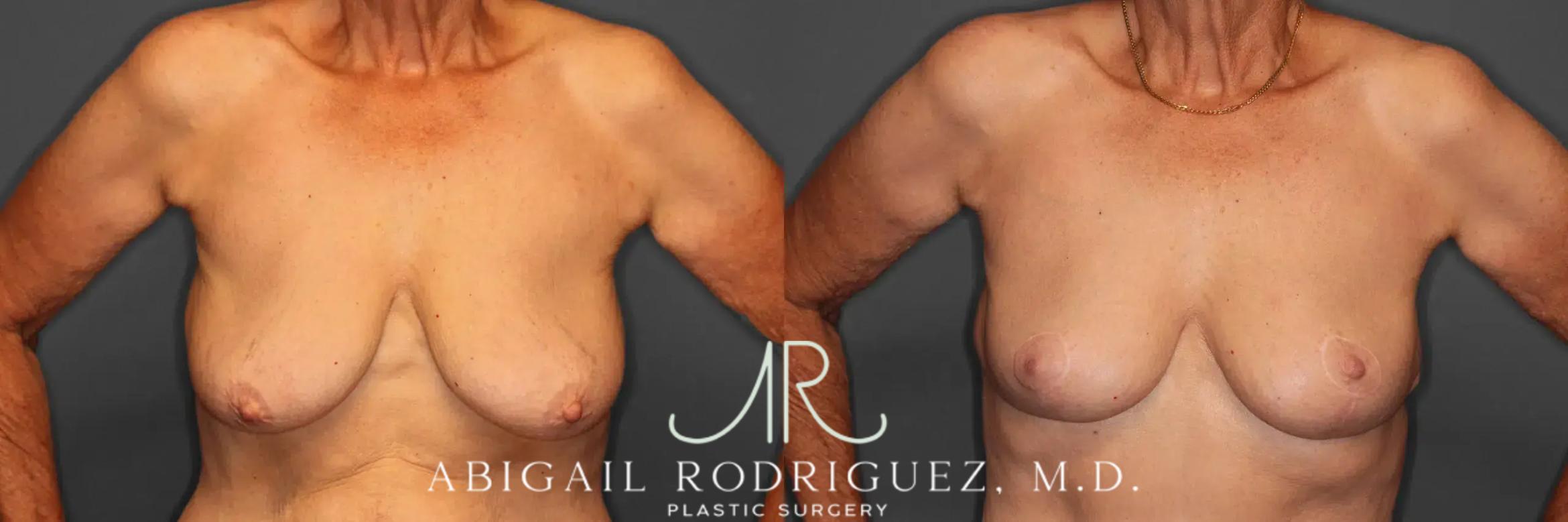 Before & After Breast Lift Case 259293 View 2 View in Houston, TX