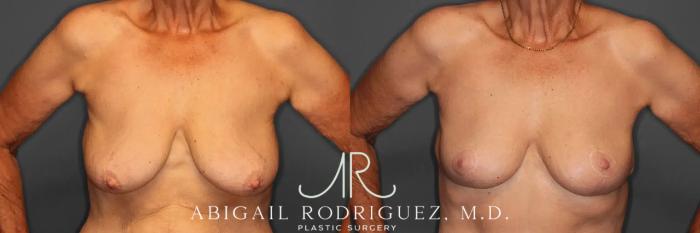 Before & After Breast Lift Case 259293 View 2 View in Houston, TX