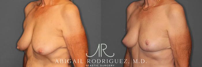 Before & After Breast Lift Case 259293 View 3 View in Houston, TX