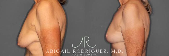 Before & After Breast Lift Case 259293 View 4 View in Houston, TX