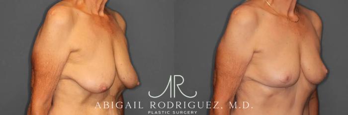 Before & After Breast Lift Case 259293 View 5 View in Houston, TX