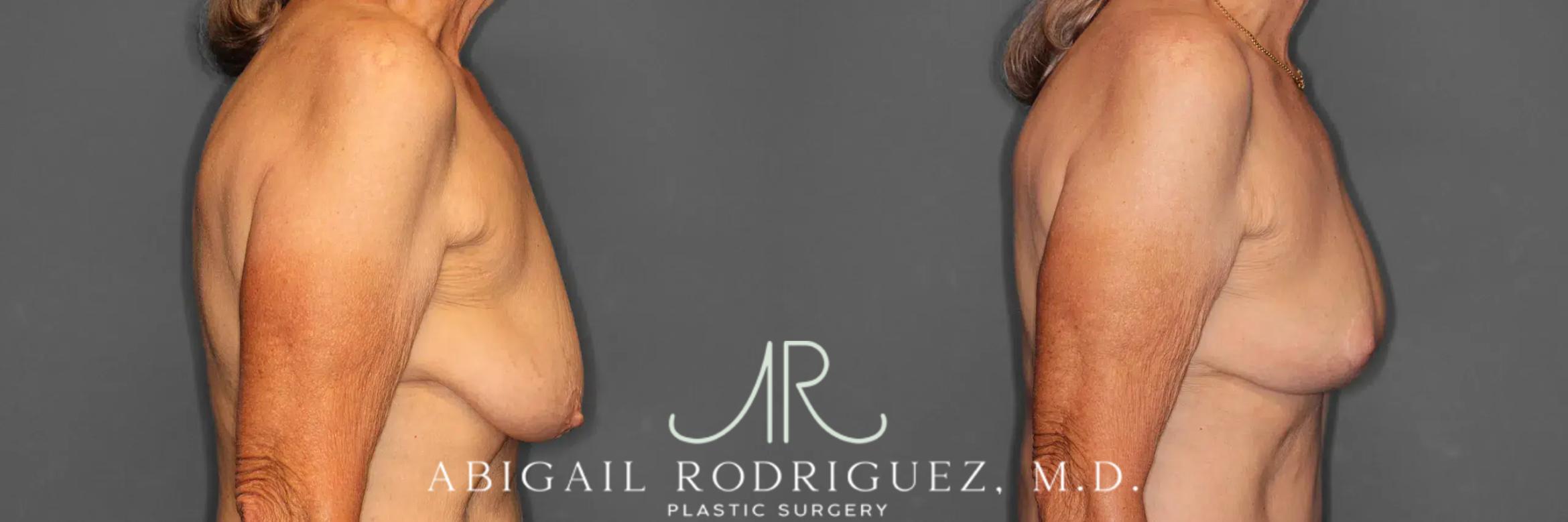 Before & After Breast Lift Case 259293 View 6 View in Houston, TX