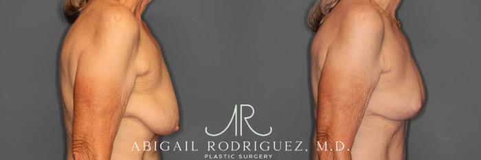 Before & After Breast Lift Case 259293 View 6 View in Houston, TX