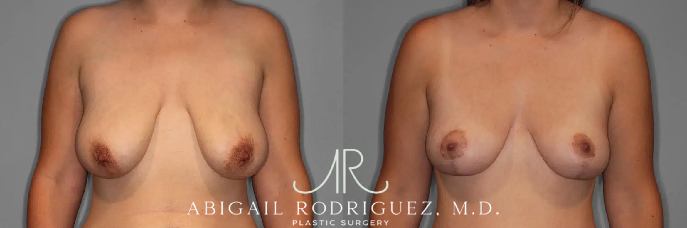 Before & After Breast Lift Case 259376 View 1 View in Houston, TX