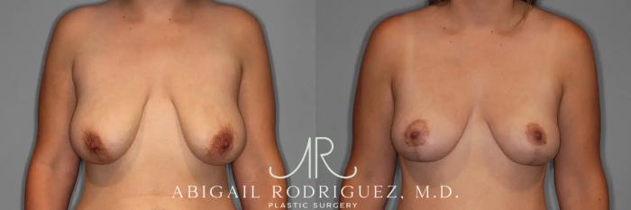 Before & After Breast Lift Case 259376 View 1 View in Houston, TX
