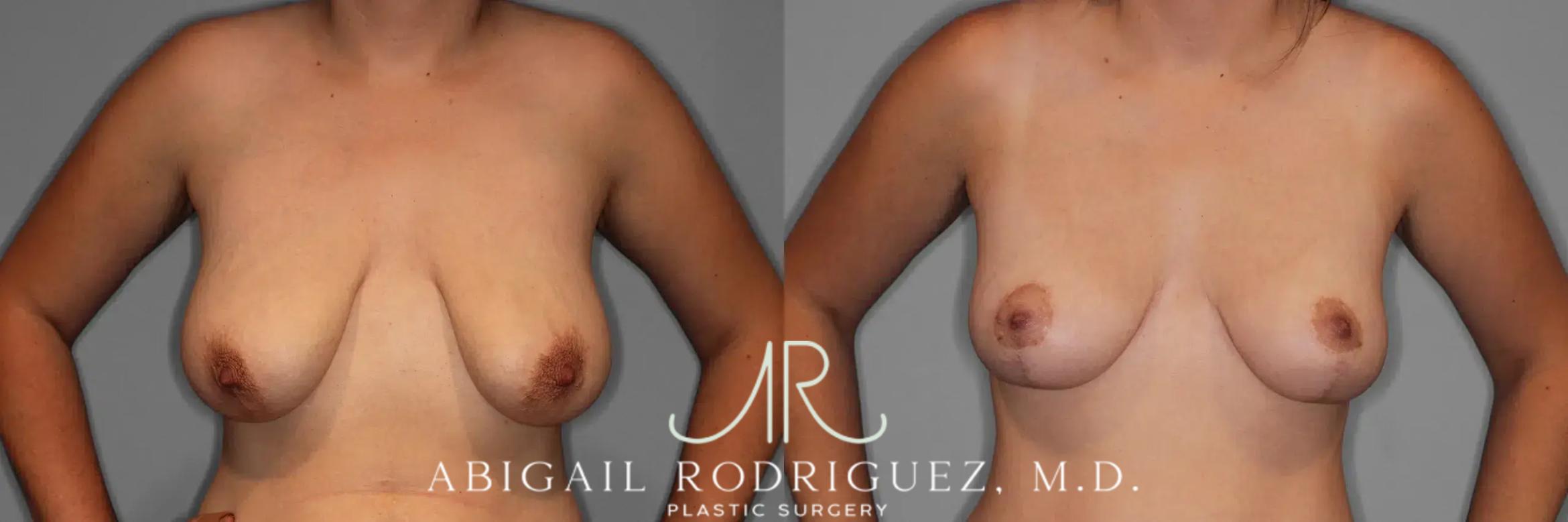 Before & After Breast Lift Case 259376 View 2 View in Houston, TX