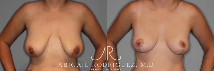 Before & After Breast Lift Case 259376 View 2 View in Houston, TX