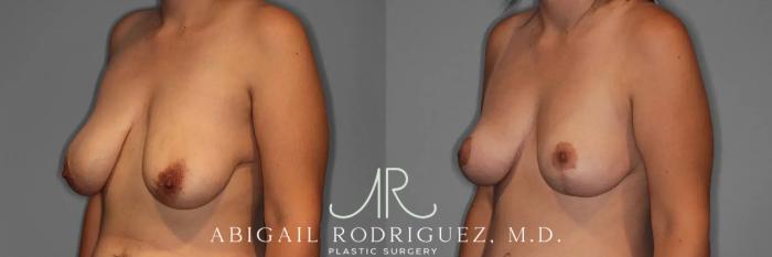 Before & After Breast Lift Case 259376 View 3 View in Houston, TX