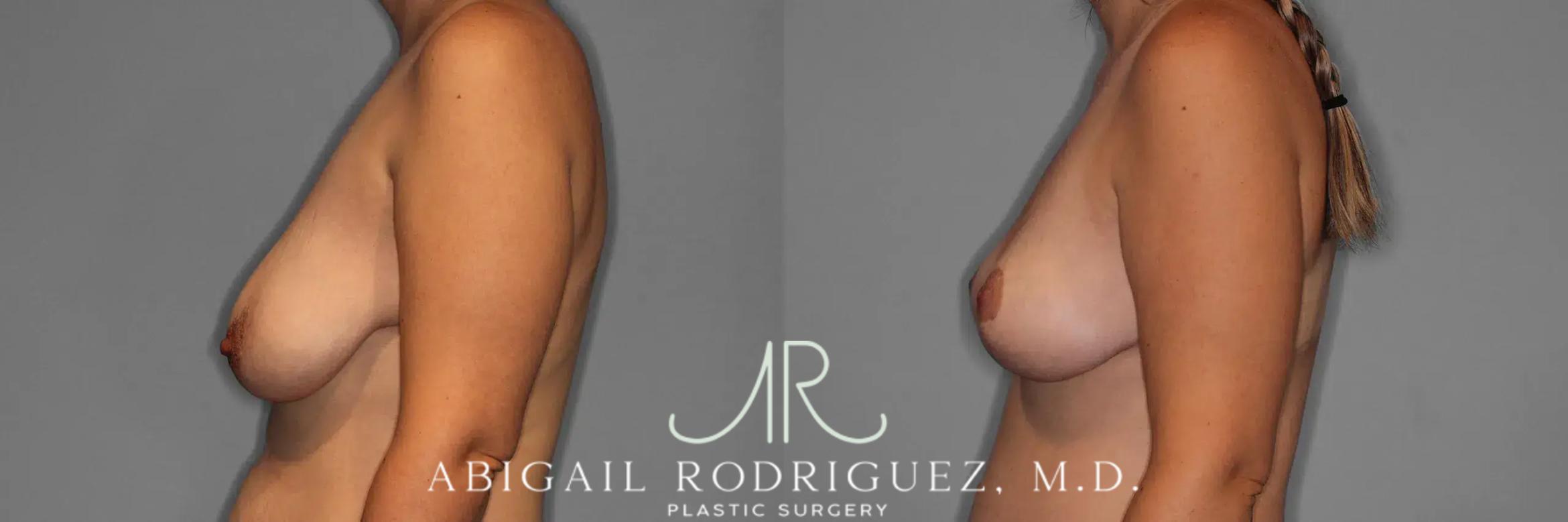 Before & After Breast Lift Case 259376 View 4 View in Houston, TX