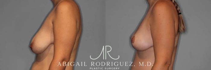 Before & After Breast Lift Case 259376 View 4 View in Houston, TX