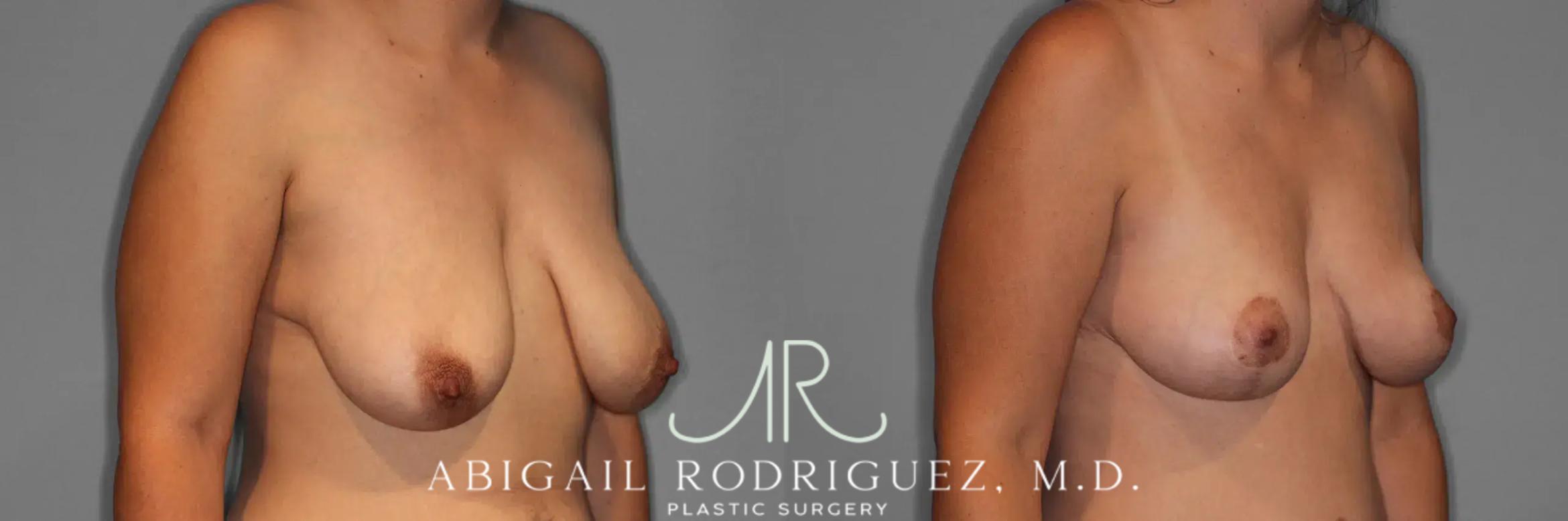 Before & After Breast Lift Case 259376 View 5 View in Houston, TX