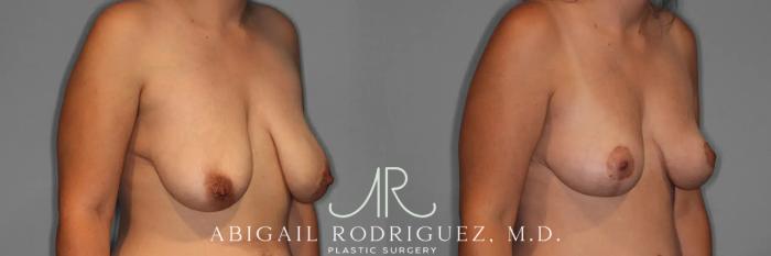 Before & After Breast Lift Case 259376 View 5 View in Houston, TX
