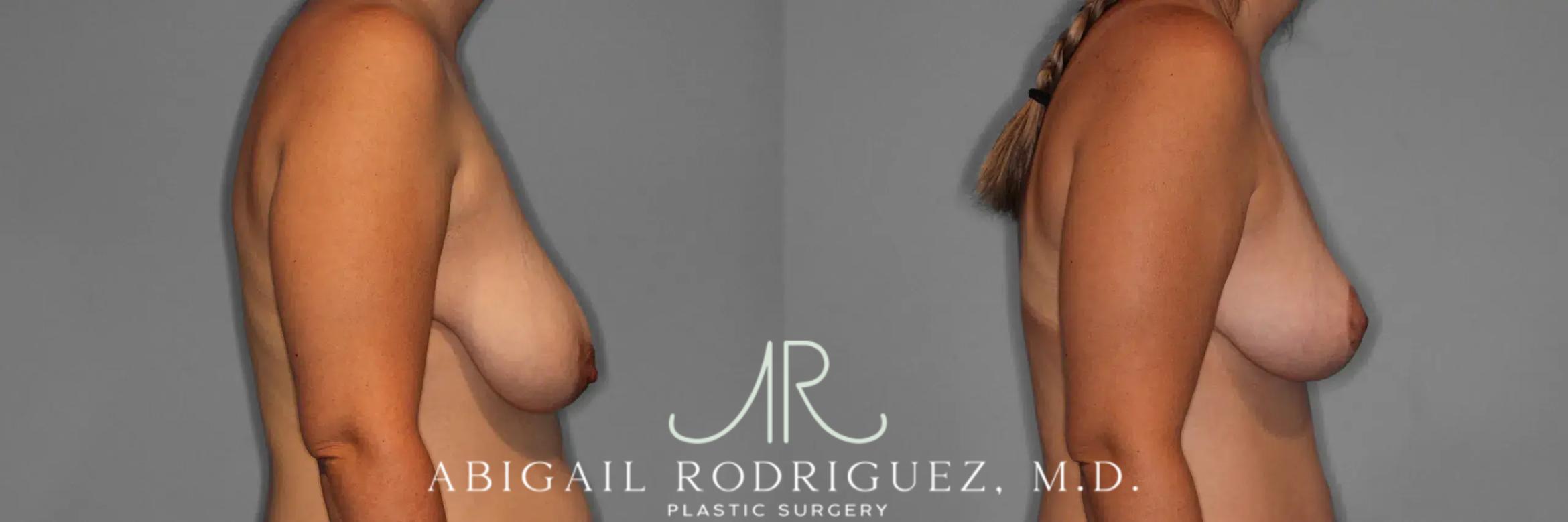 Before & After Breast Lift Case 259376 View 6 View in Houston, TX