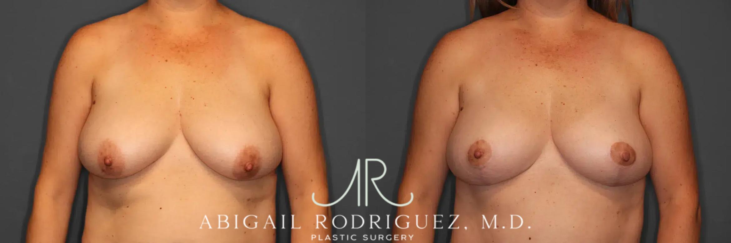 Before & After Breast Lift Case 259458 View 1 View in Houston, TX