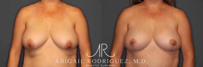 Before & After Breast Lift Case 259458 View 1 View in Houston, TX