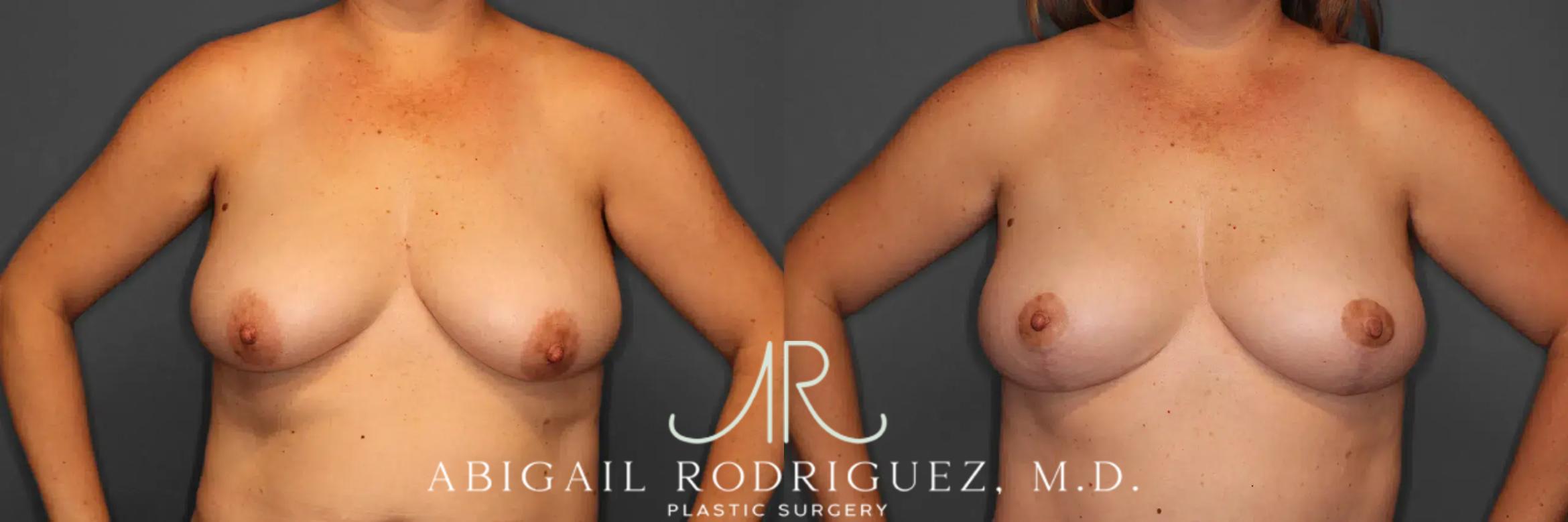Before & After Breast Lift Case 259458 View 2 View in Houston, TX
