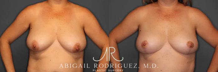 Before & After Breast Lift Case 259458 View 2 View in Houston, TX