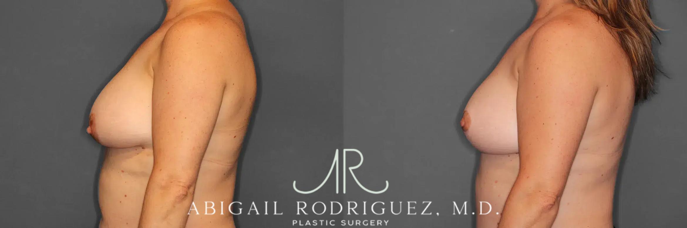 Before & After Breast Lift Case 259458 View 3 View in Houston, TX