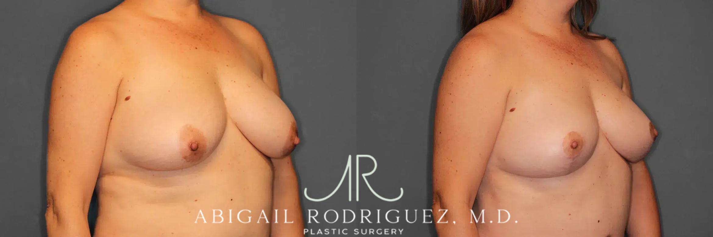 Before & After Breast Lift Case 259458 View 4 View in Houston, TX