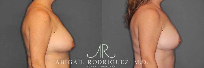 Before & After Breast Lift Case 259458 View 5 View in Houston, TX
