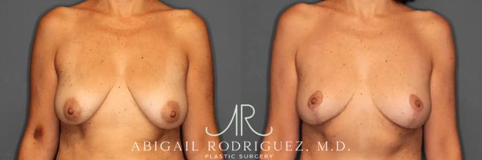 Before & After Breast Lift Case 259494 View 1 View in Houston, TX