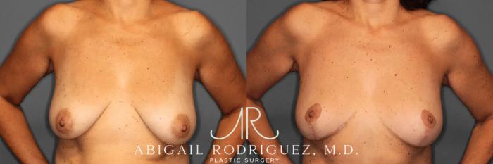 Before & After Breast Lift Case 259494 View 2 View in Houston, TX