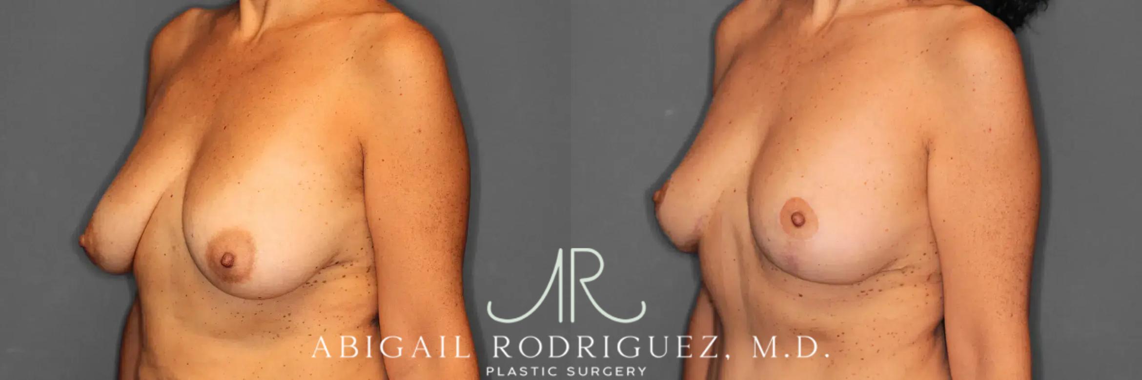 Before & After Breast Lift Case 259494 View 3 View in Houston, TX