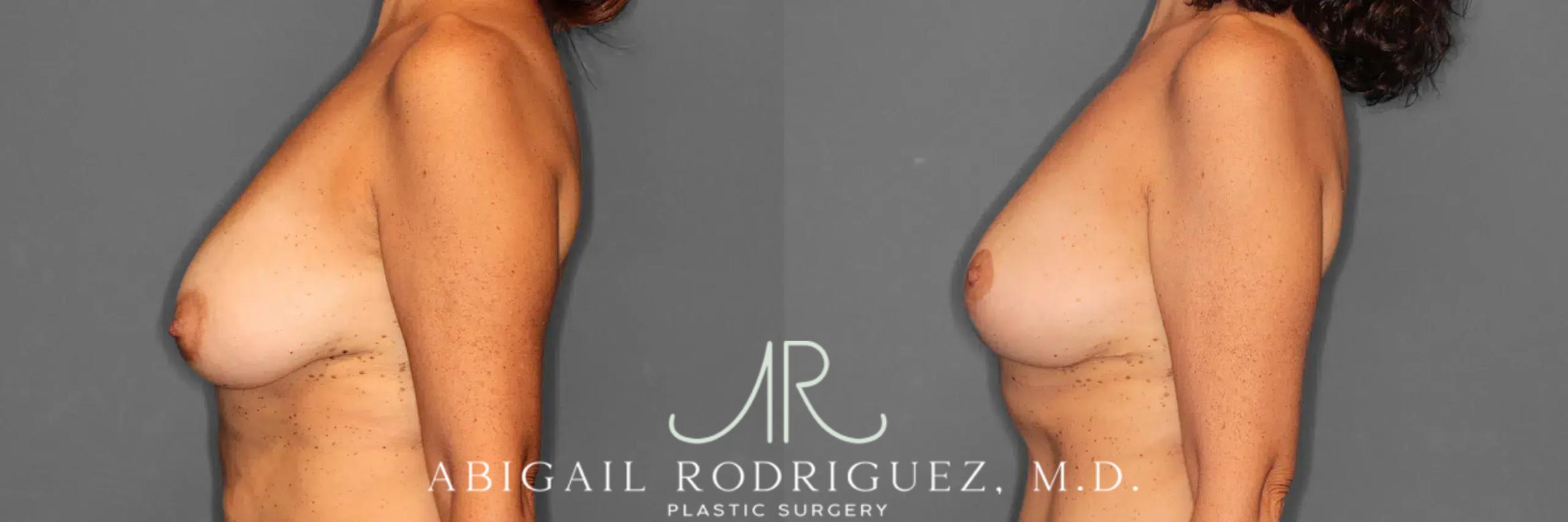 Before & After Breast Lift Case 259494 View 4 View in Houston, TX