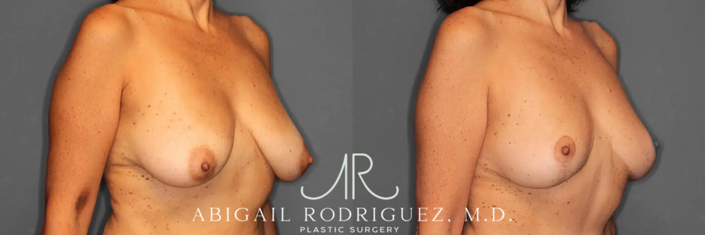 Before & After Breast Lift Case 259494 View 5 View in Houston, TX