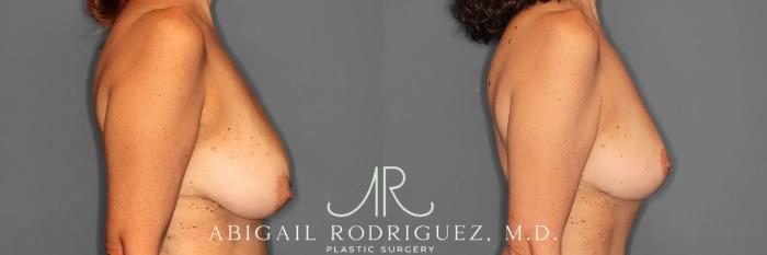 Before & After Breast Lift Case 259494 View 6 View in Houston, TX