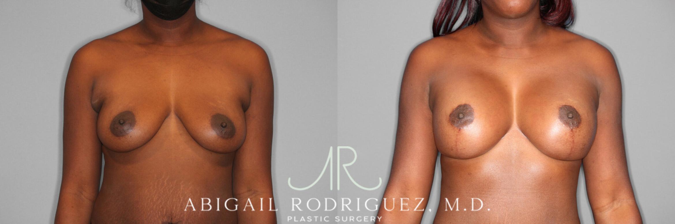 Before & After Breast Lift with Augmentation Case 253989 View 1 View in Houston, TX