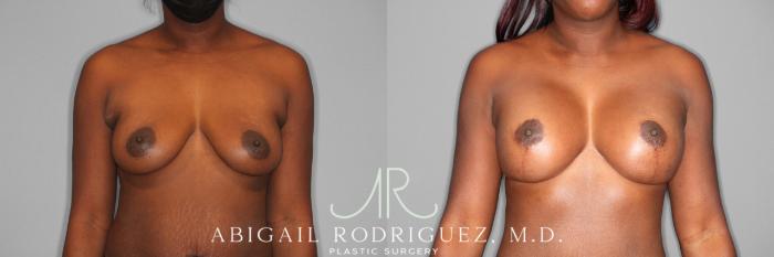 Before & After Breast Lift Case 253989 View 1 View in Houston, TX