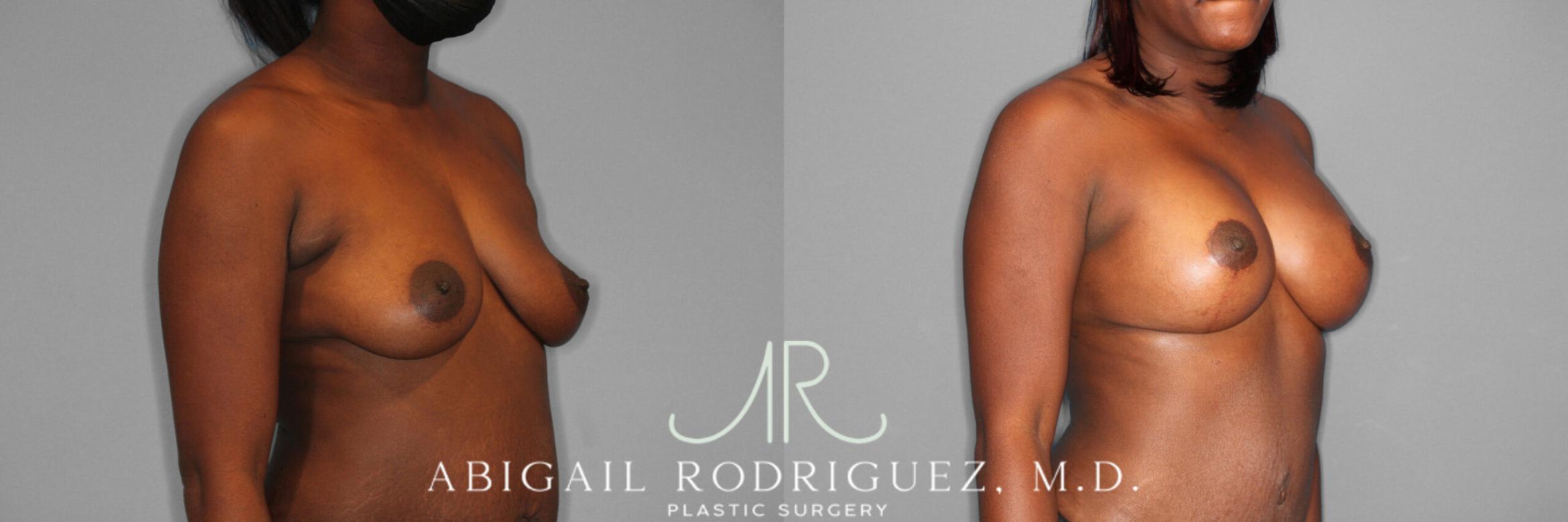 Before & After Breast Lift with Augmentation Case 253989 View 2 View in Houston, TX