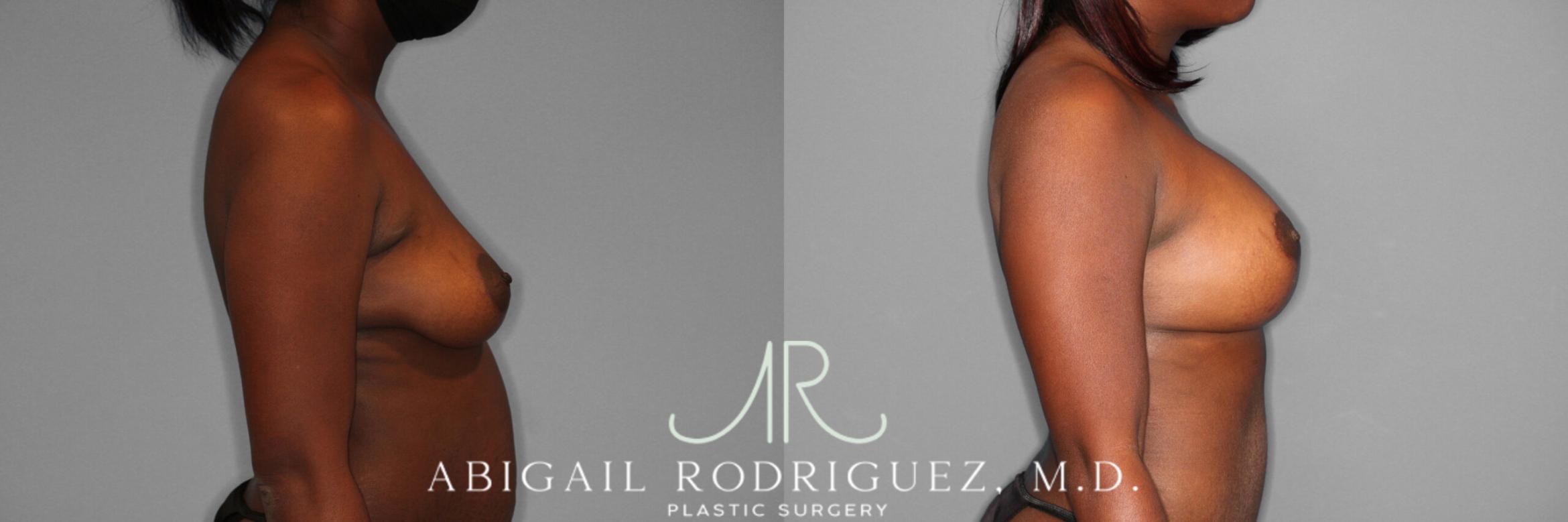 Before & After Breast Lift with Augmentation Case 253989 View 3 View in Houston, TX