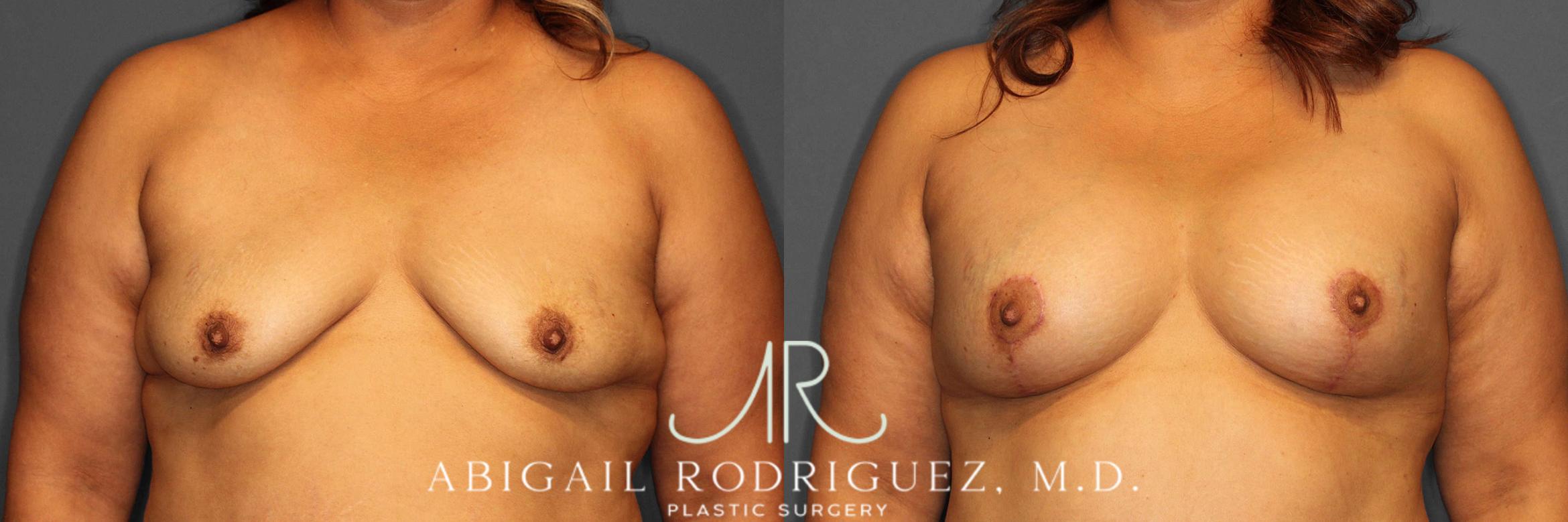 Before & After Breast Lift with Augmentation Case 254520 View 1 View in Houston, TX