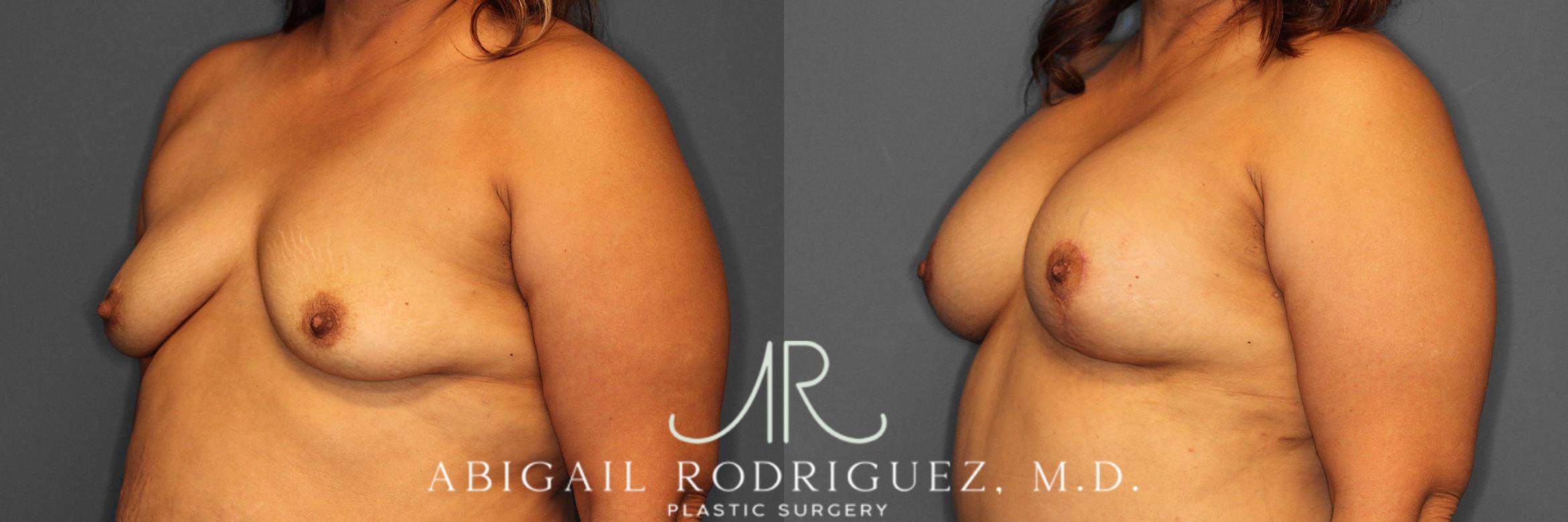 Before & After Breast Lift with Augmentation Case 254520 View 2 View in Houston, TX