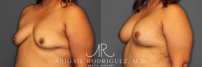 Before & After Breast Lift with Augmentation Case 254520 View 2 View in Houston, TX