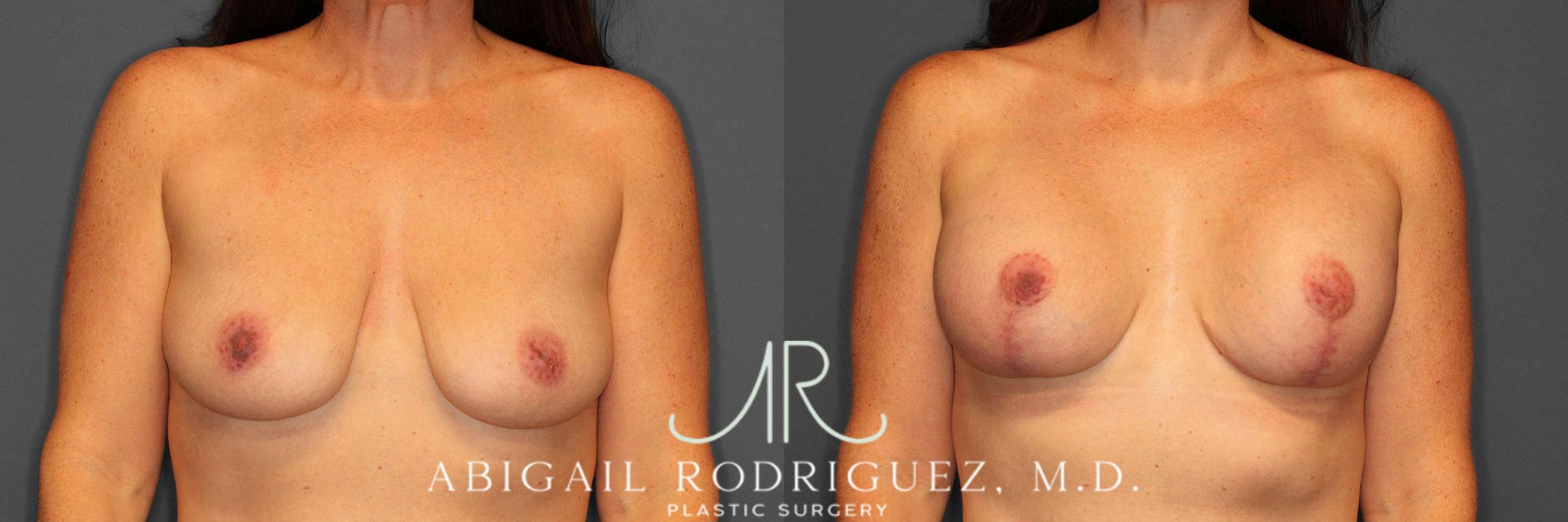 Before & After Breast Lift with Augmentation Case 254552 View 1 View in Houston, TX