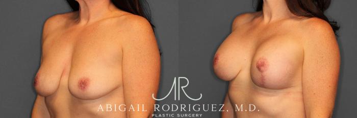 Before & After Breast Lift with Augmentation Case 254552 View 2 View in Houston, TX