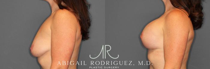 Before & After Breast Lift with Augmentation Case 254552 View 3 View in Houston, TX
