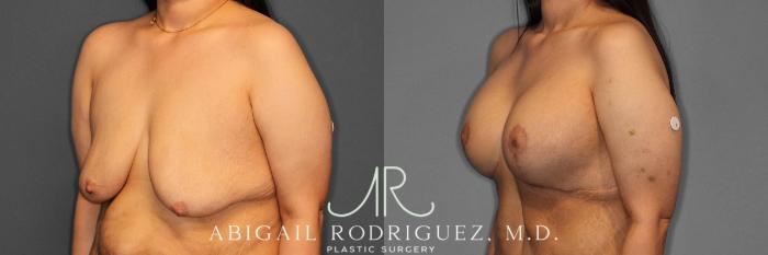 Before & After Breast Lift with Augmentation Case 254861 View 2 View in Houston, TX