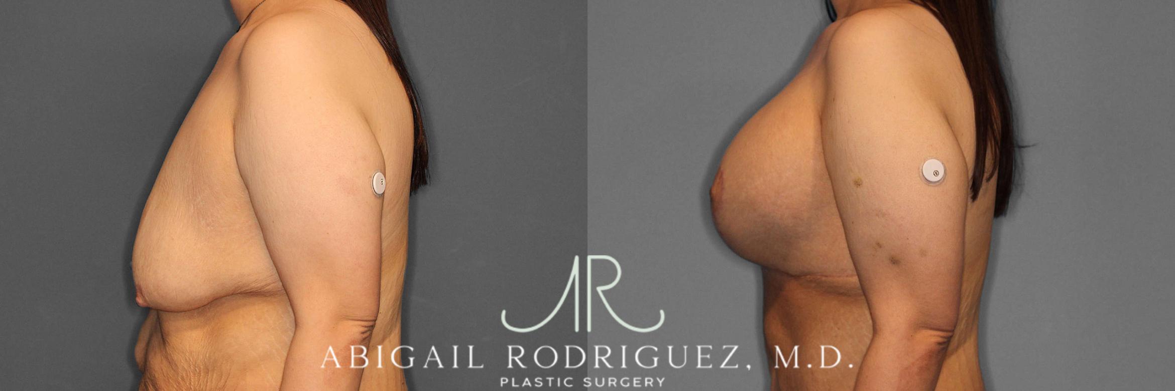 Before & After Breast Lift with Augmentation Case 254861 View 3 View in Houston, TX