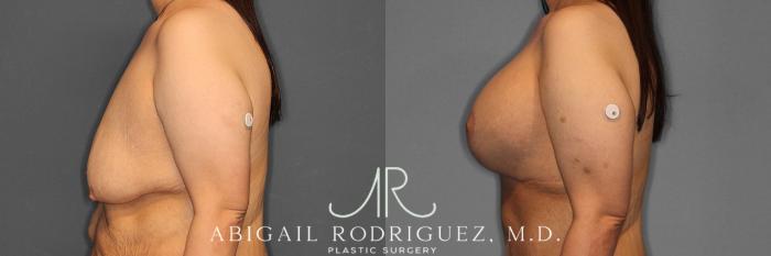 Before & After Breast Lift with Augmentation Case 254861 View 3 View in Houston, TX