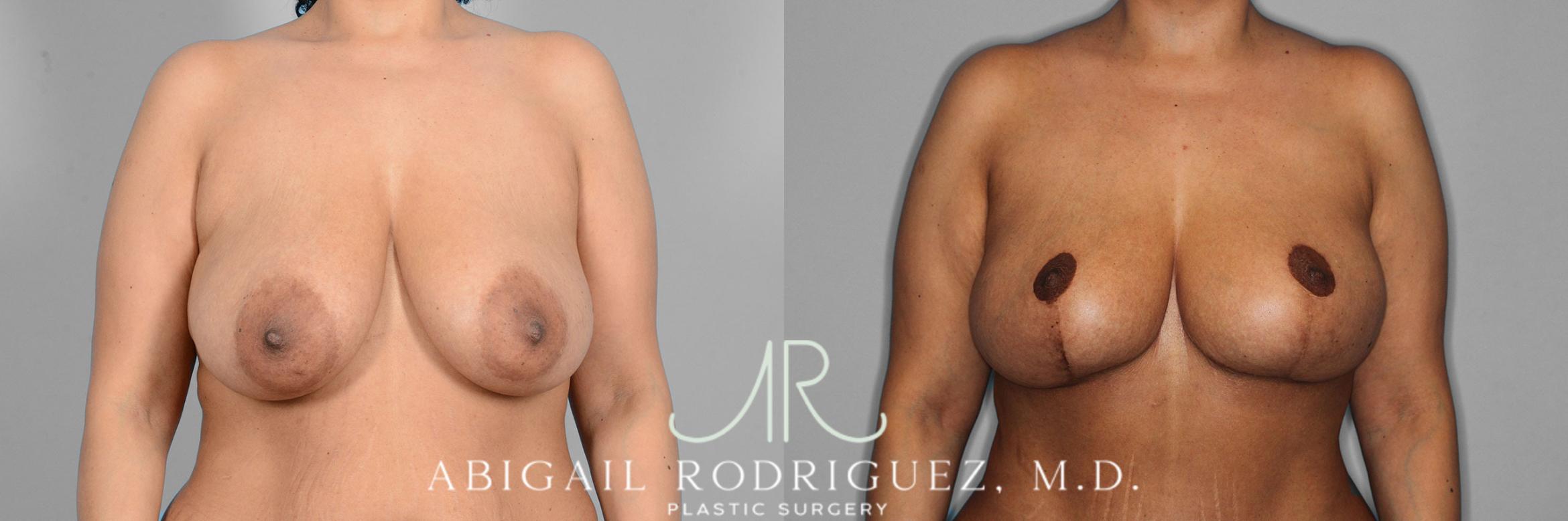 Before & After Breast Lift with Augmentation Case 257421 View 1 View in Houston, TX