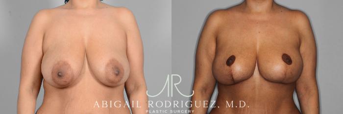 Before & After Breast Reduction Case 257421 View 1 View in Houston, TX